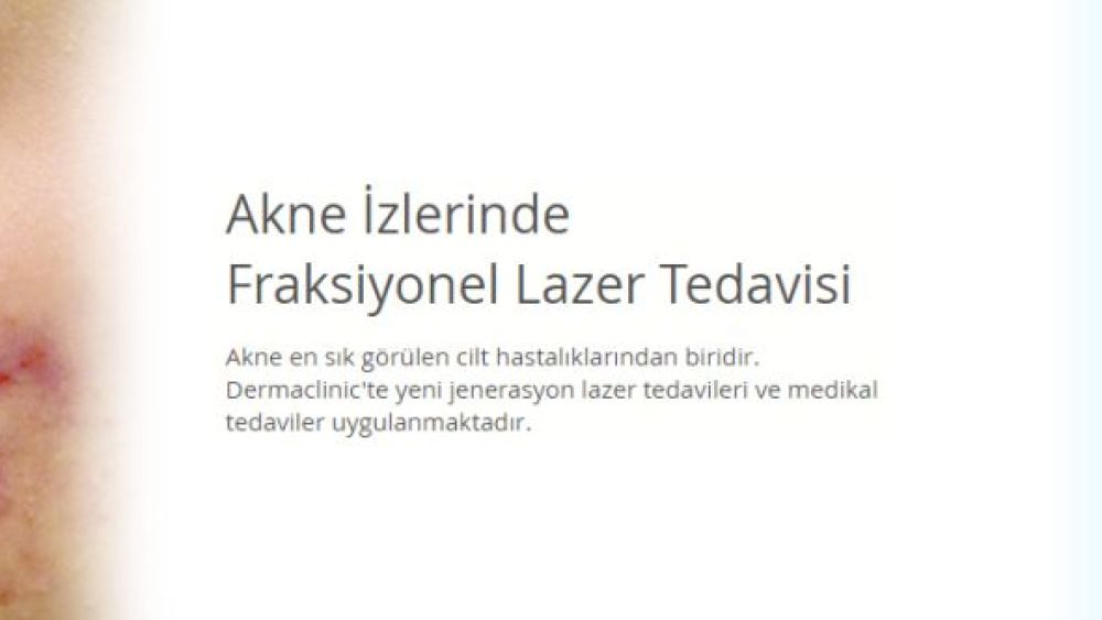 Bursa’da Sivilce ve Akne İzlerine Kalıcı Çözüm Dermaclinic’te