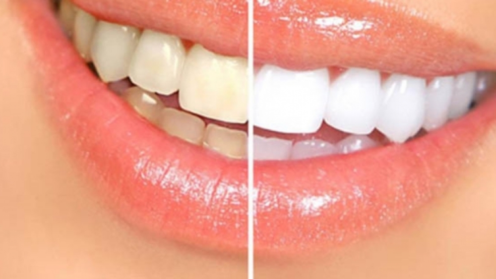 Diş Beyazlatma Nasıl Gerçekleşir?