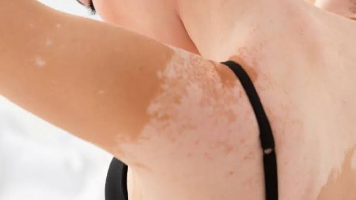 Nişantaşı’nda Excimer Lazer ile Vitiligo Tedavisi